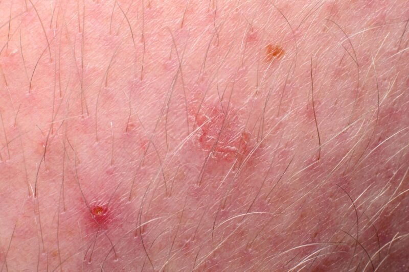 Tacroz (Tacrolimus 0.1%) Cream: Non-Steroid Therapy for Eczema and Inflammatory Skin Conditions